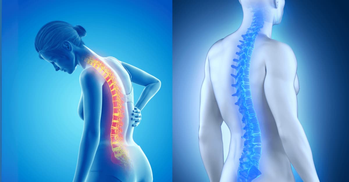 Illustration of osteoporosis showing weakened bones