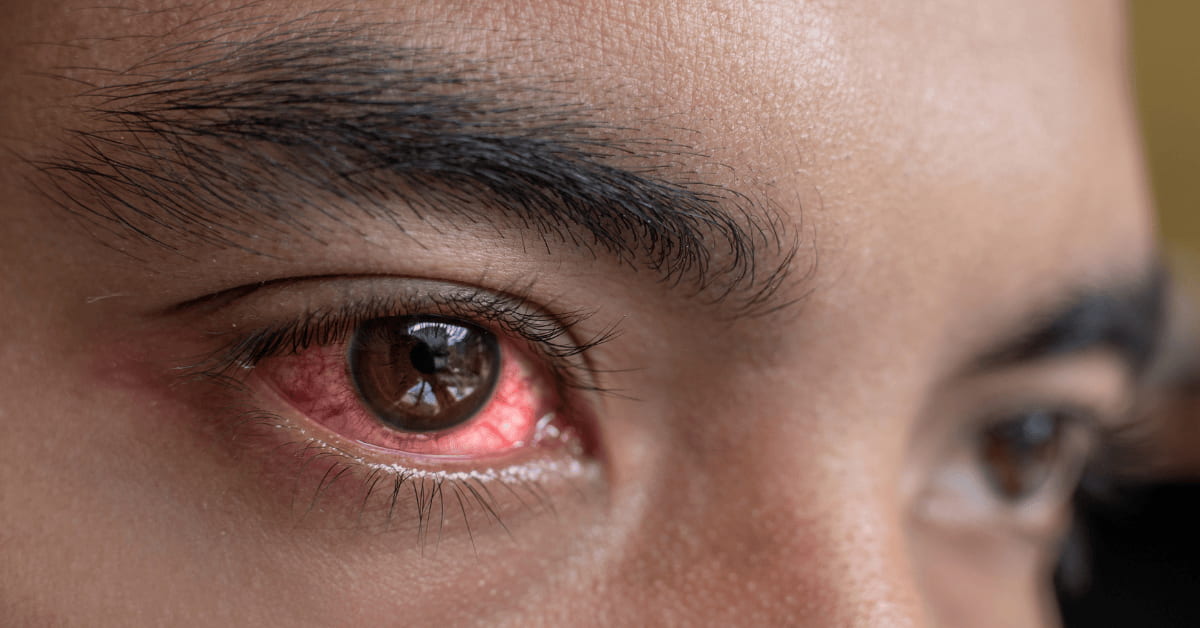 Close-up of a red, inflamed eye showing a common symptom of an eye infection